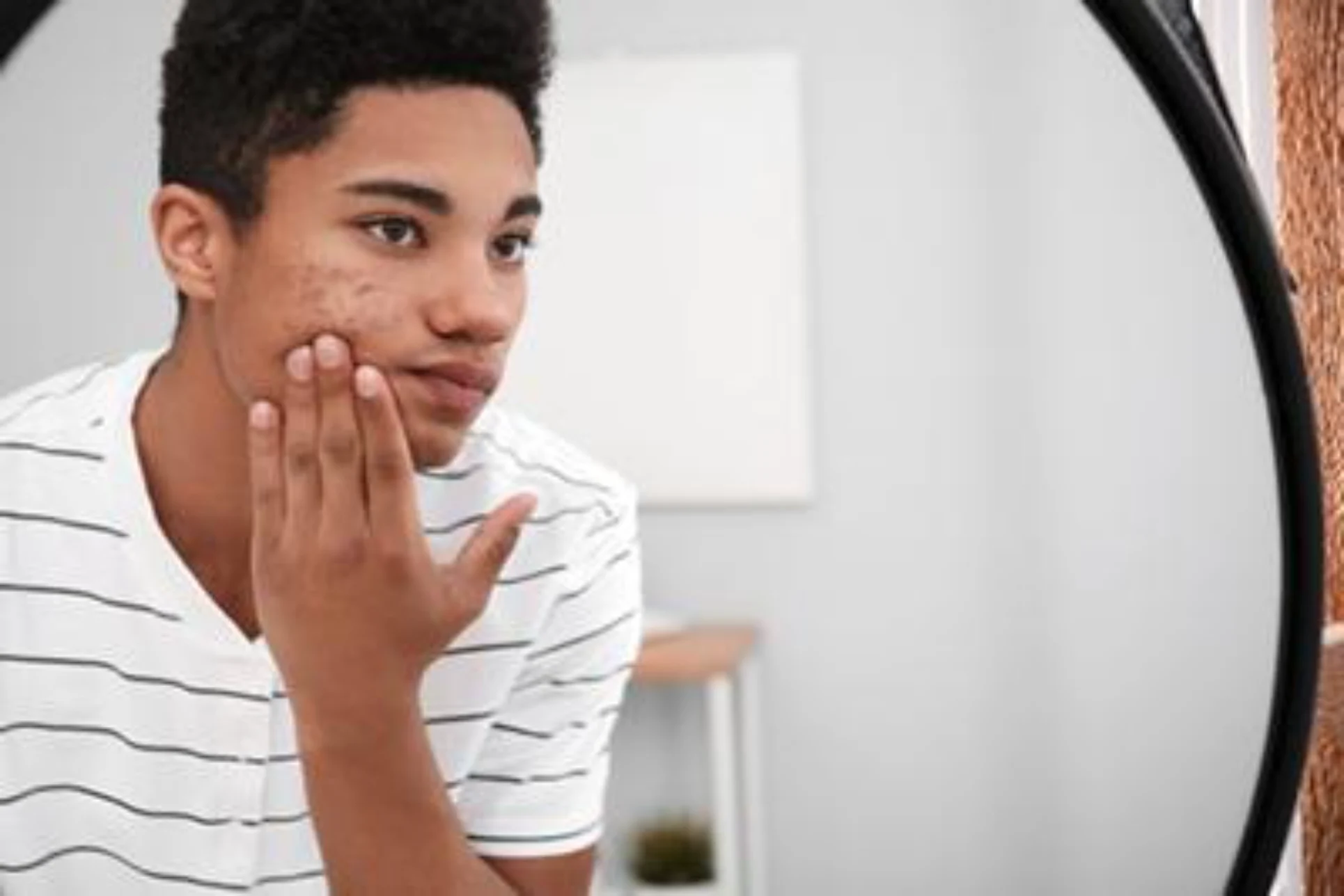 Teen acne treatment in Ithaca NY